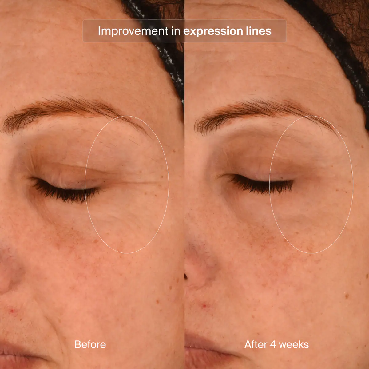 Before and after comparison of expression lines on a person's face.